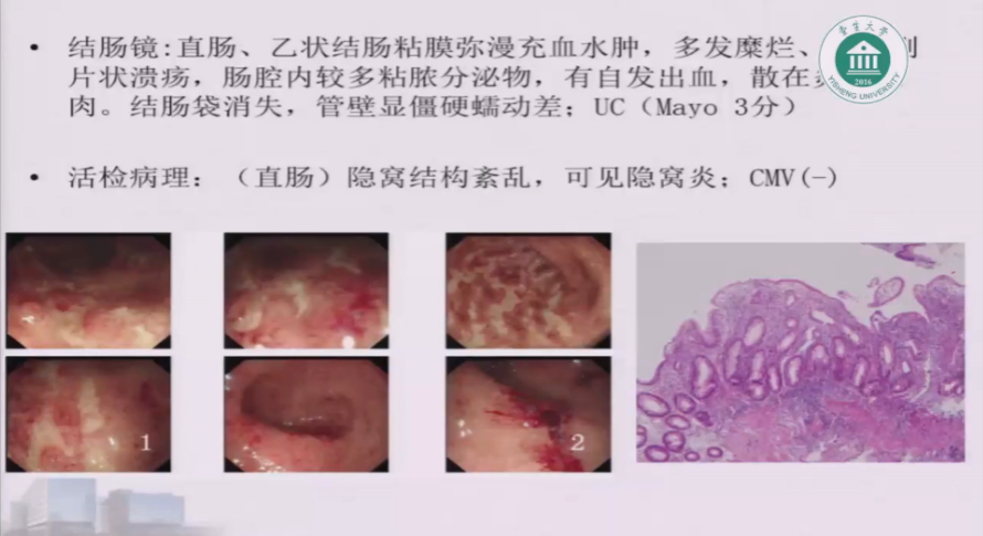 两个月内血栓易溶掉的秘密